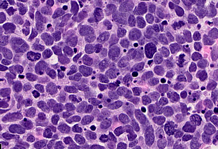 scientific image of small cell lung carcinoma cells shows pink and lavender clusters