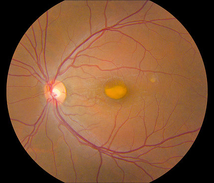 Image of an eyeball, red branches of veins, with an egg-yolk-shaped mark in the center