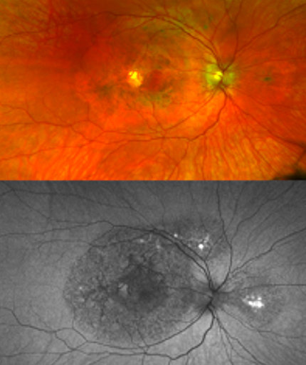 Retinal images of a patient with a TIMP3 mutation
