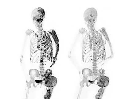 Two human skeletons side by side, the first showing many dark patches representing lesions