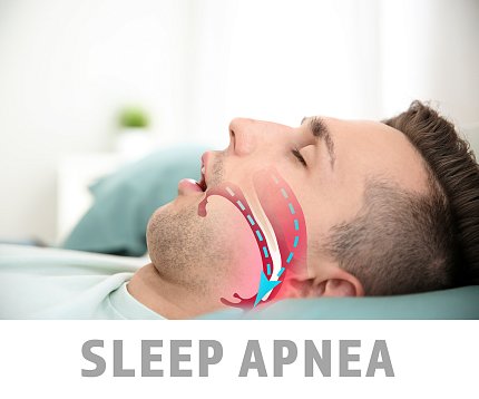 Diagram overlaid over a man's face shows the airway during disruptive sleep apnea.