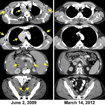 Schwarz-weiße CAT-Scans zeigen Bereiche mit Krebs im Juni 2009 und rechts einen sauberen Scan ohne Tumore