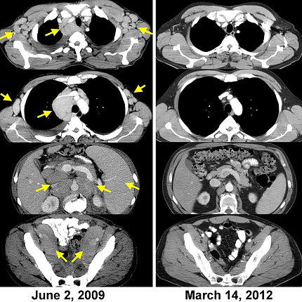 Black and white CAT scans show areas of cancer in June 2009 and, on the right, a clean scan with no tumors