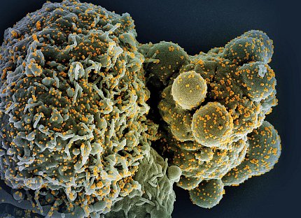 A microscopic image of a cell infected with the virus that causes Covid-19