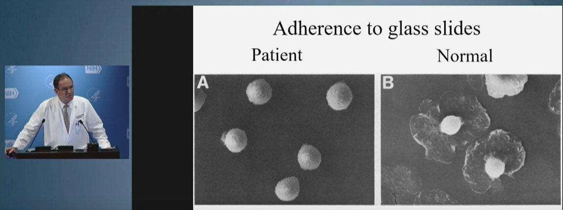 Holland at podium, on left. Slides on right show small balls on a glass plate, of a patient, and normal neutrophils, that spread out on glass like fried eggs