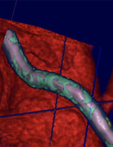 An artery covered in green from plaque crosses over a 3D model heart shown in red.