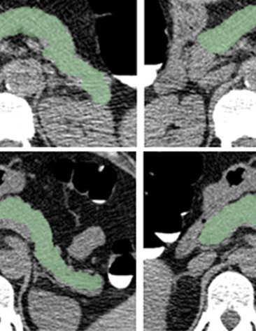 series of CAT scan images of pancreases of 2 patients