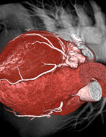 A medical image of a heart muscle