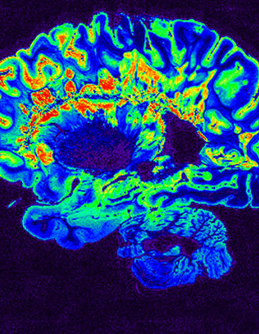 Brain scan image colored blue with several areas highlighted in green and orange