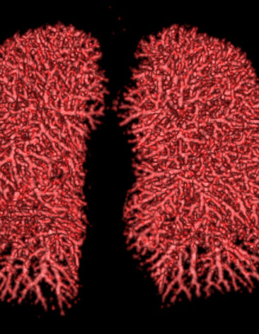 Computed tomography 3D rendering of the lungs of a person who is recovering from Covid-19.