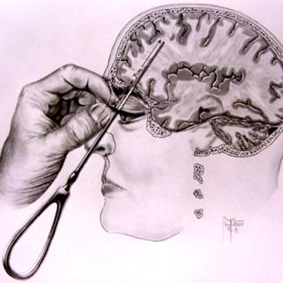 A drawing of hand using Freeman’s icepick-inspired transorbital lobotomy instrument on patient